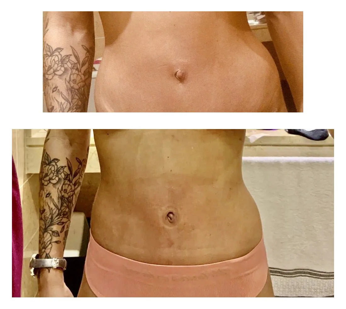 CONFORMADOR CILINDRICO UMBILICAL - Imagen 3